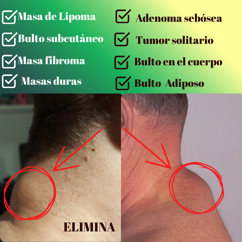 LIPOMAX: SPRAY ELIMINADOR DE LIPOMAS
